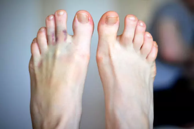 اثر ویروس کرونا بر پوست:انگشتان پا