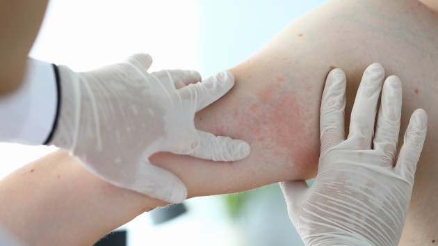 اثر ویروس کرونا بر پوست:التهابات پوستی