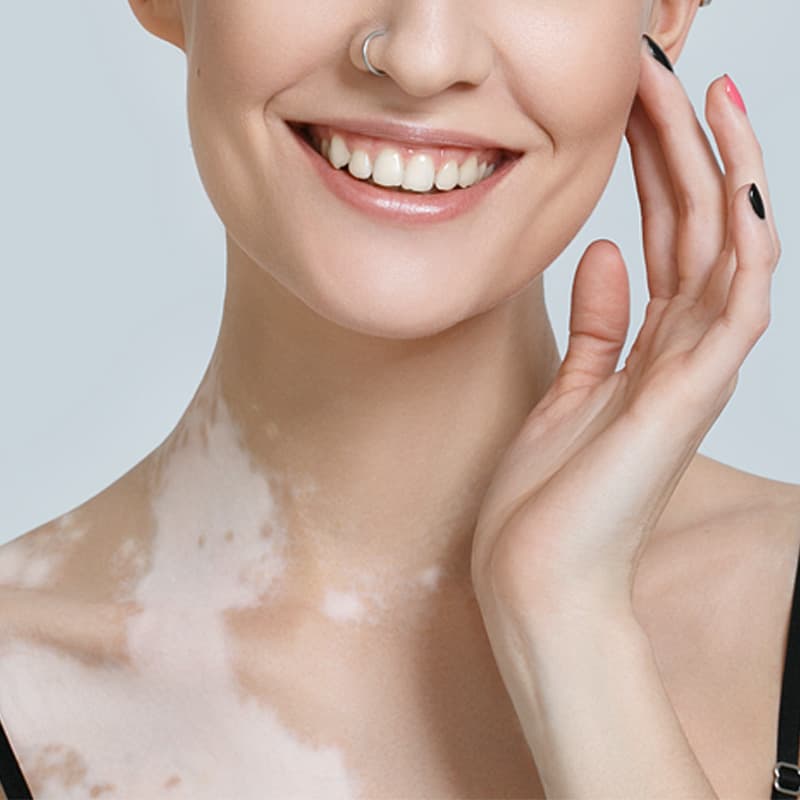 بیماری لک و پیس (Vitiligo)